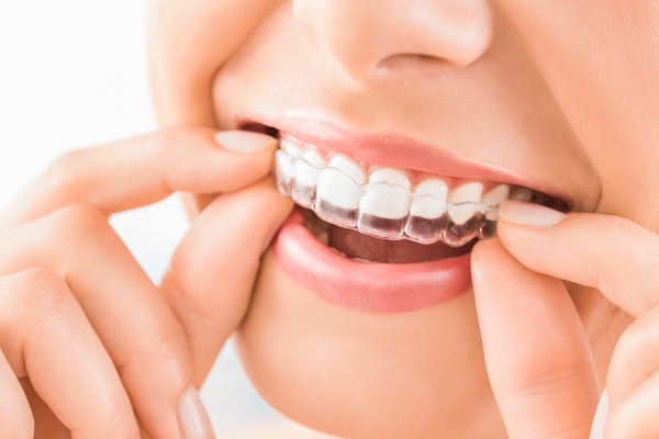 Can Invisalign Be Used for Top and Bottom Teeth? from Citrus Grove Orthodontics in Whittier, CA
