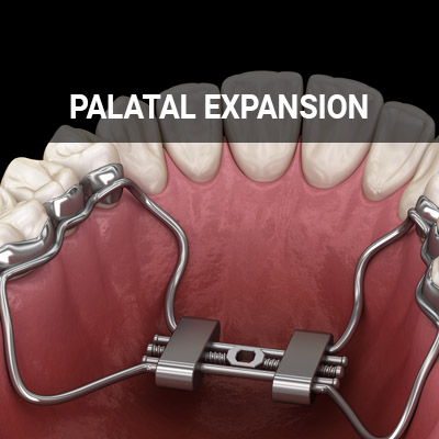 Navigation image for our Palatal Expansion page